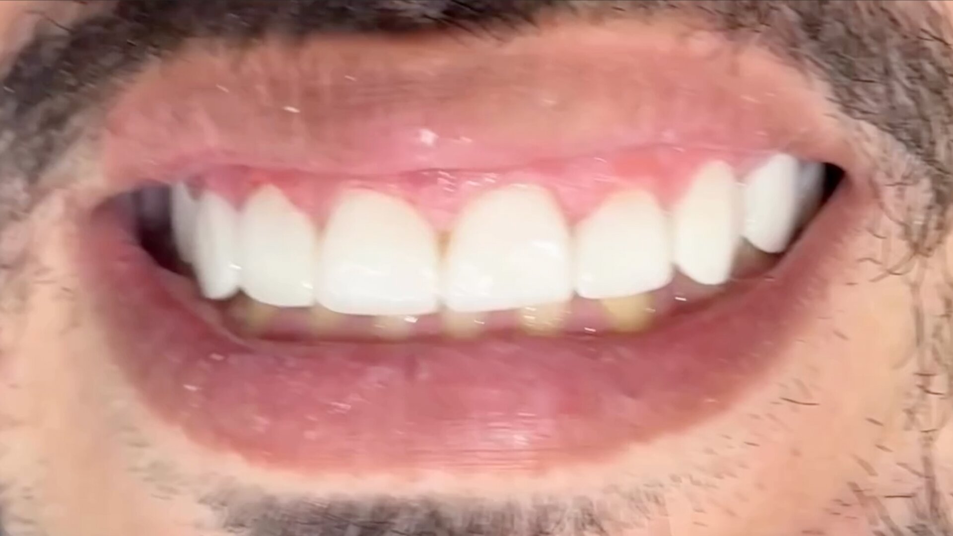 Depois — Lentes em Resina