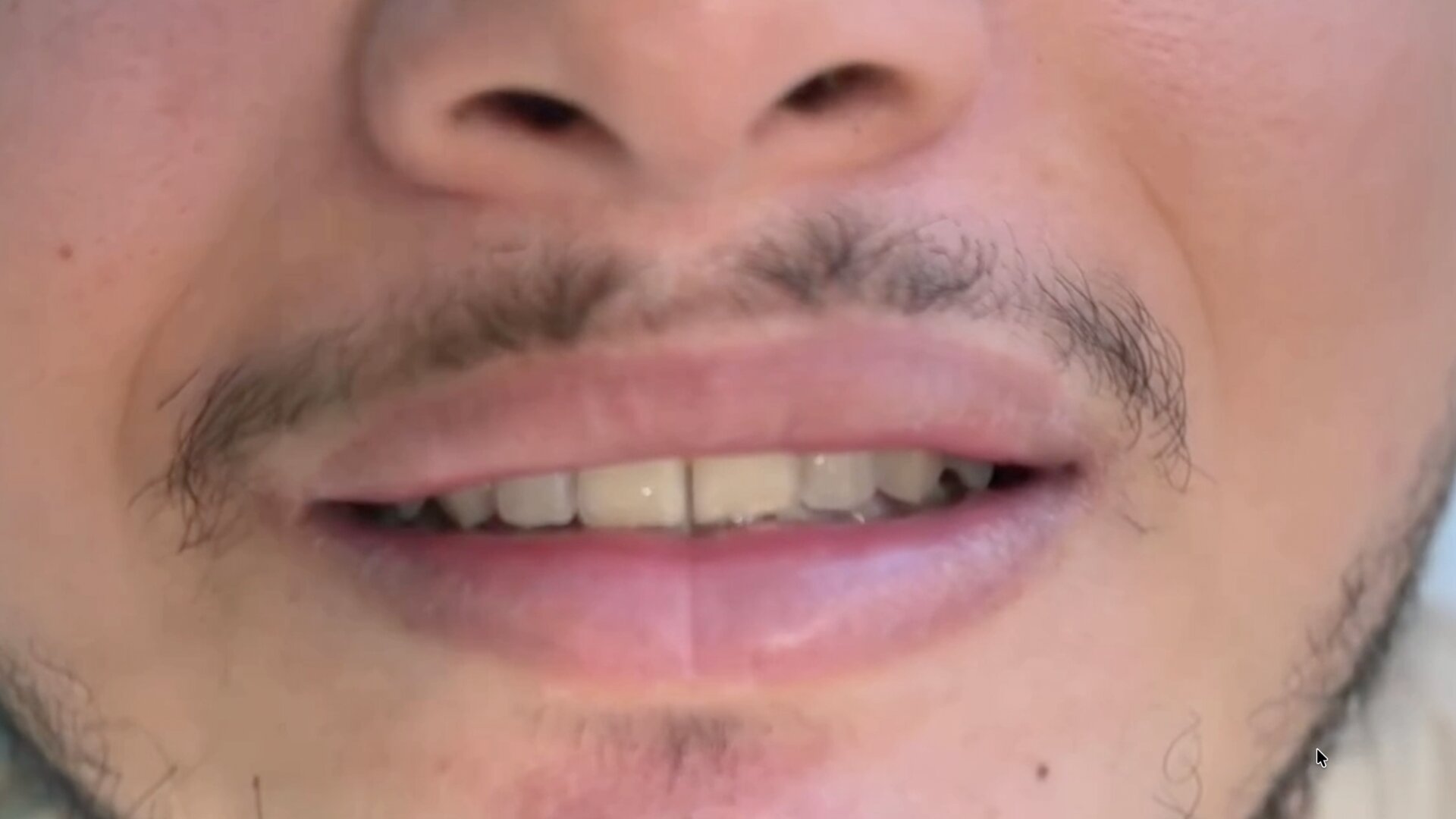 Antes — Harmonização do Sorriso